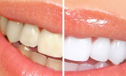 Sistema de Blanqueamiento Zoom